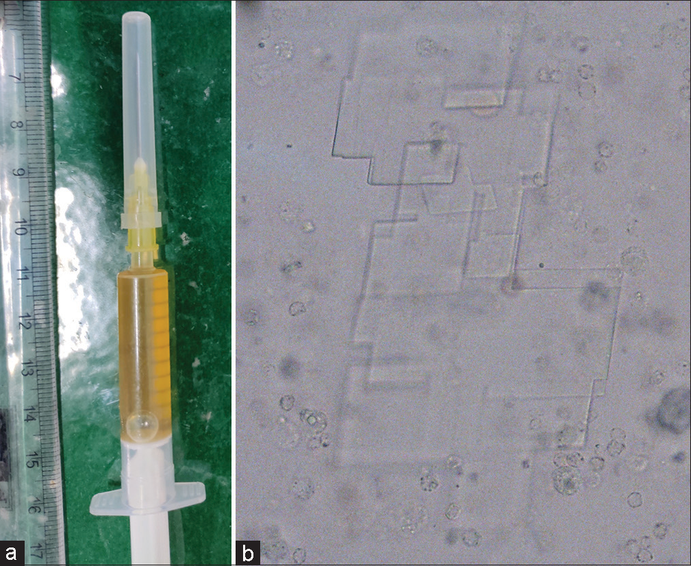 (a) Shimmering gold-colored aspirate and (b) rectangular cholesterol crystals with a notched corner when observed under a microscope (original magnification ×400).