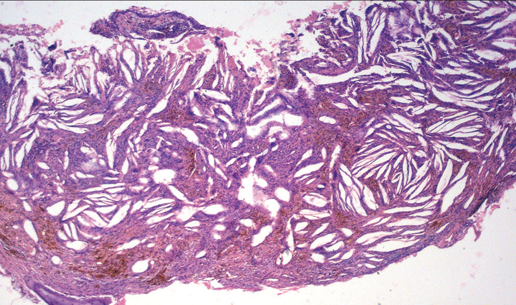 Histopathological picture of a cholesterol granuloma (H and E, original magnification ×100).