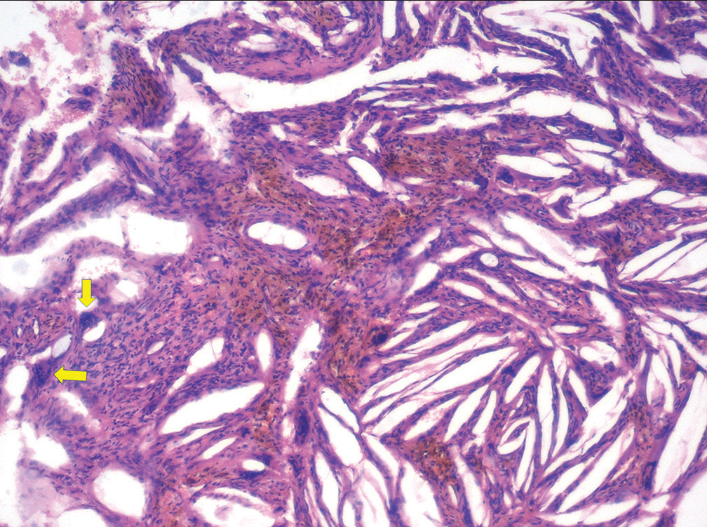 Higher magnification showing multinucleated giant cells (arrows) and hemorrhagic elements associated with cholesterol clefts (H and E, original magnification ×400).